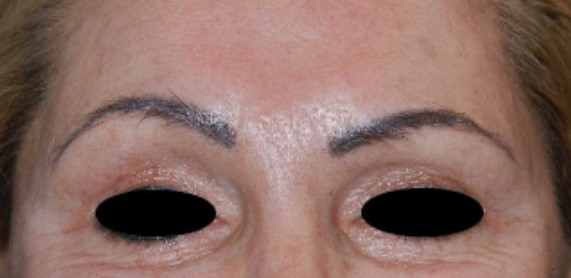 brow lift before