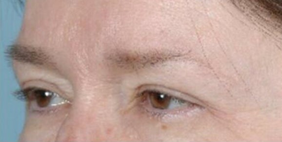 brow lift after
