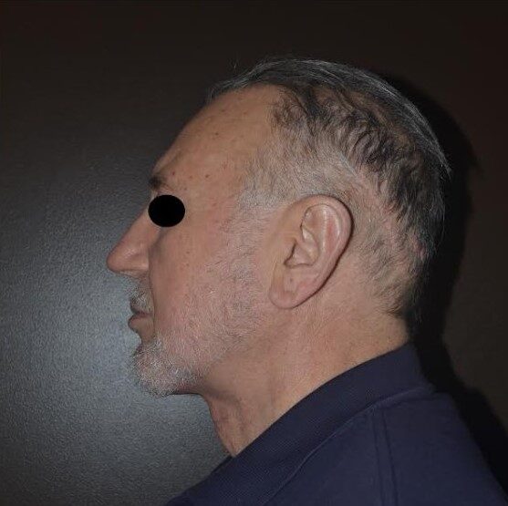 facial implants after