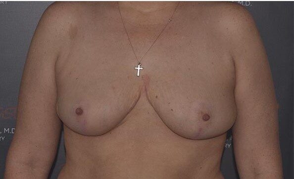 breast reduction after