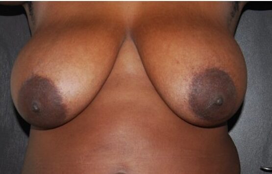 breast reduction before