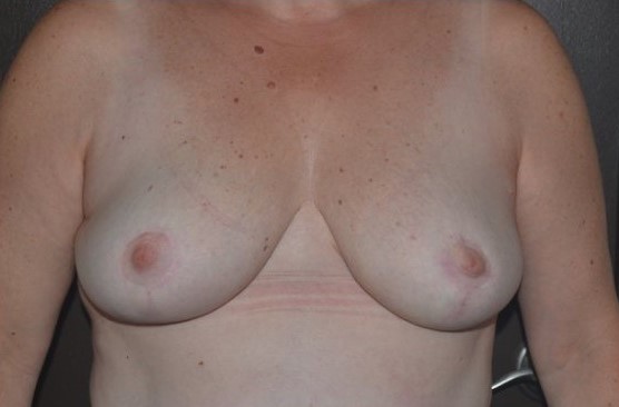 breast reduction after