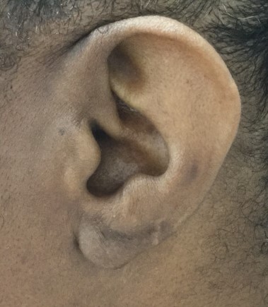 torn earlobe repair after