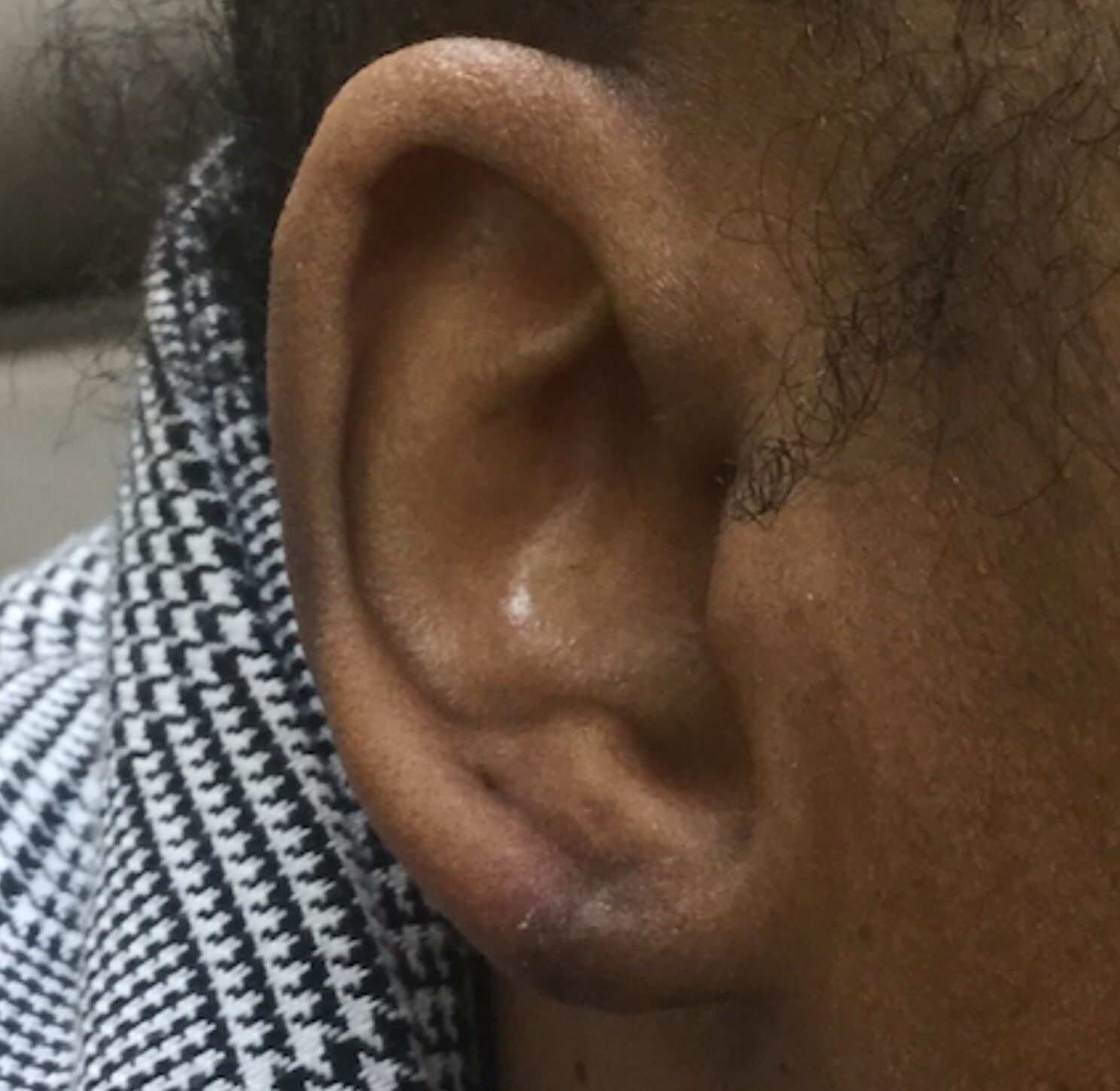 torn earlobe repair after