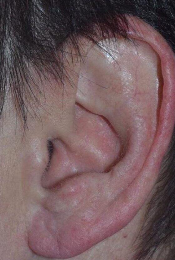 Ear Lobe Repair in Westchester NY