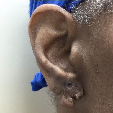 torn earlobe repair before
