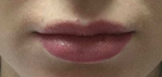 lip filler after