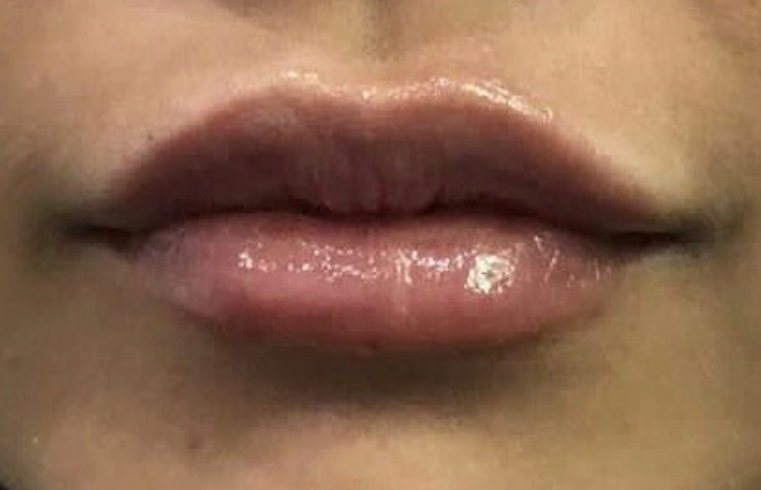 lip filler after