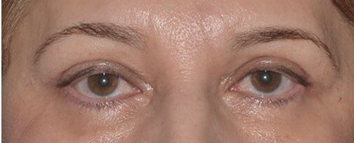 lower eyelid after