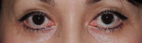 lower eyelid after
