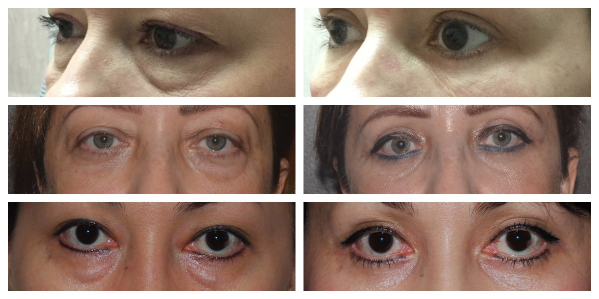 lower eyelid surgery before and afters