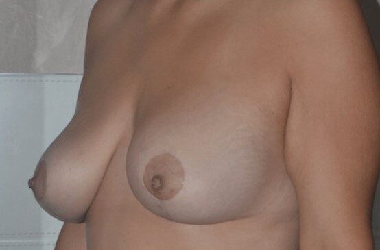 mastopexy after