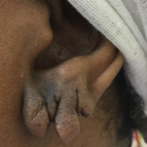 torn earlobe repair before