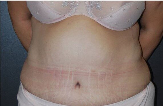 tummy tuck after