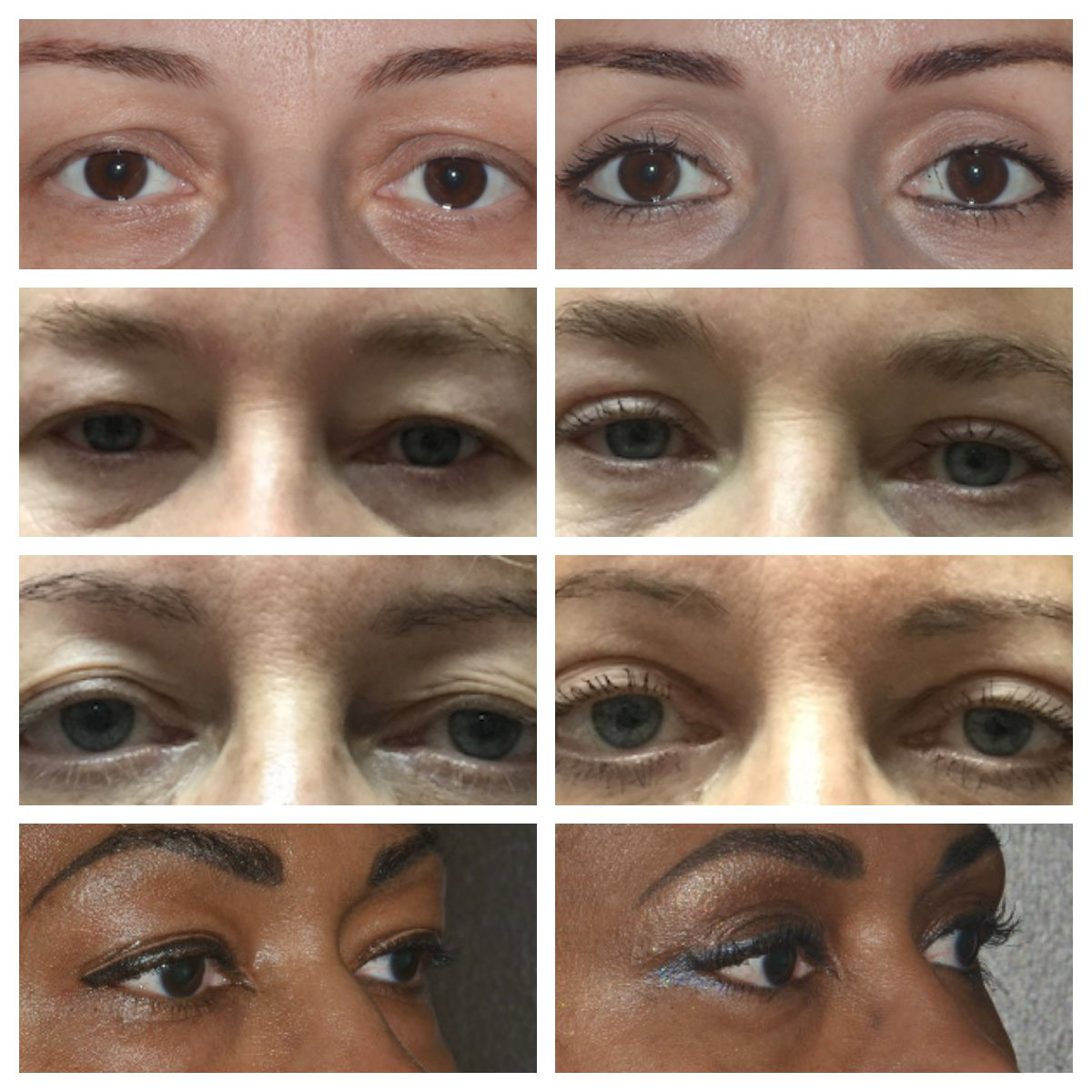 upper eyelid surgery before and after