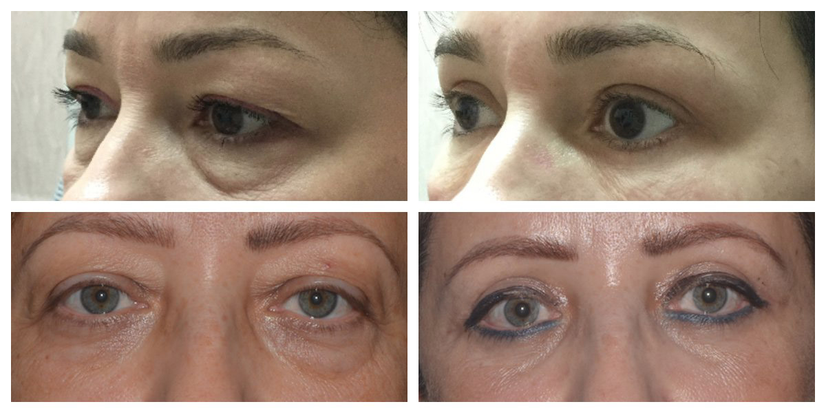 upper and lower eyelid surgery before and afters