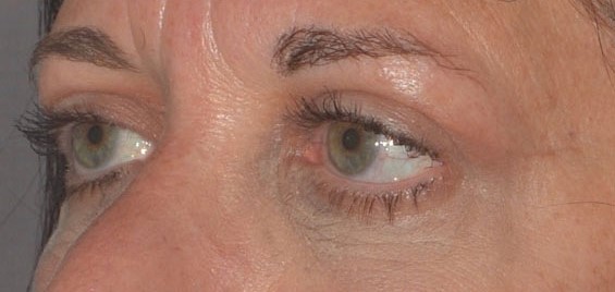upper eyelid after