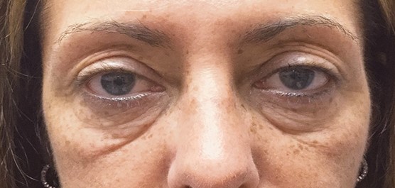upper lower eyelid before