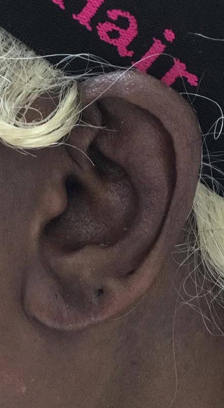 earlobe repair after