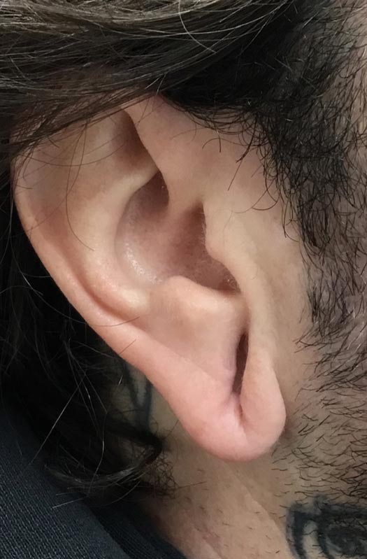 Jenova Rain » Stretched or Split Ear Lobe Reconstruction, Ear Hole Repair  Without Surgery - portrestaurant.com.pg